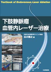 下肢静脈瘤血管内レーザー治療